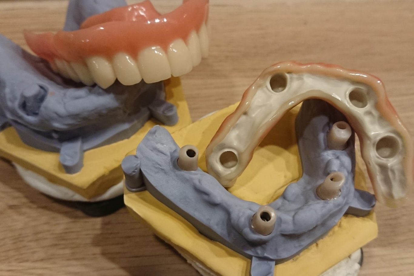 Implantat Zahnprothesen und Zahnmodelle auf einem Tisch angeordnet.